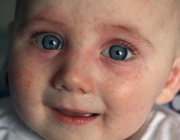 Allergic Reaction - Symptoms and causes of allergy 1 Allergic Reaction