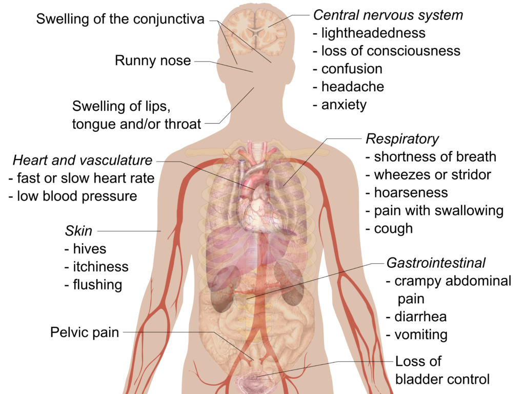 Allergic Reaction - Symptoms and causes of allergy 2 Signs and symptoms of anaphylaxis